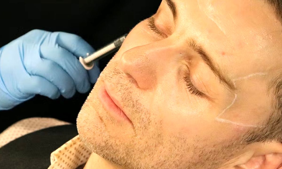 بهترین برند فیلر شقیقه: معرفی ۱۰ برند برتر و راهنمای انتخاب