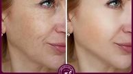 یکی از ماندگارترین روش های جوانسازی پوست! ماندگاری هایفوتراپی صورت چقدر است ؟

