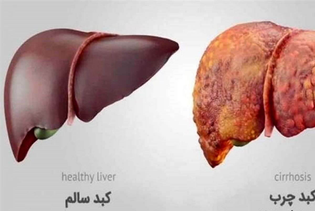 کبد چرب تان را این طور درمان کنید+ جزئیات